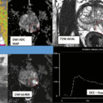 MRI images of prostate analysis.
