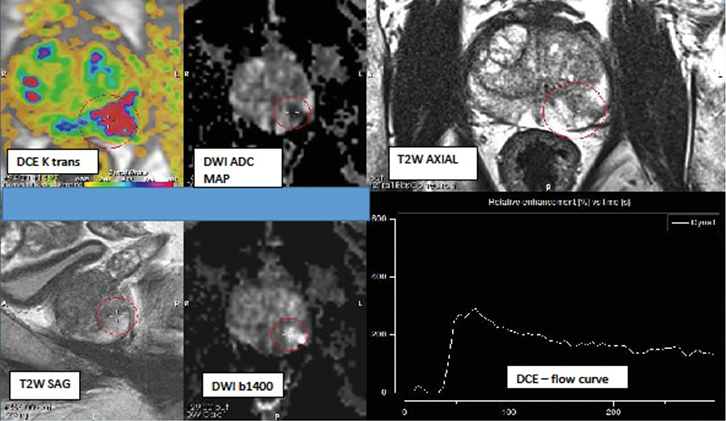 MRI images of prostate analysis.